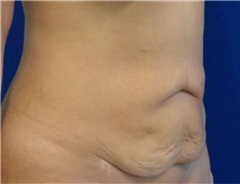 Tummy Tuck Before Photo by Munique Maia, MD; Tysons Corner, VA - Case 48934