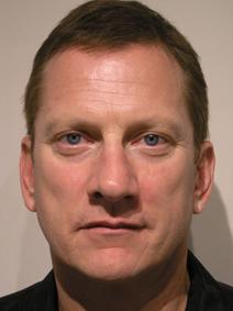 Eyelid Surgery Before Photo by Joseph Fodero, MD; Florham Park, NJ - Case 9073