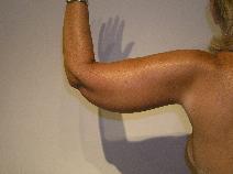 Arm Lift After Photo by Joseph Fodero, MD; Florham Park, NJ - Case 9107