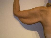Arm Lift Before Photo by Joseph Fodero, MD; Florham Park, NJ - Case 9107