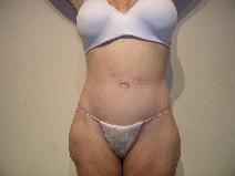 Body Contouring After Photo by Joseph Fodero, MD; Florham Park, NJ - Case 9124