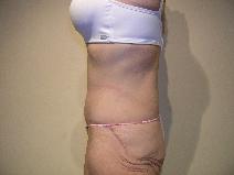 Body Contouring After Photo by Joseph Fodero, MD; Florham Park, NJ - Case 9124