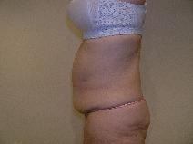 Body Contouring Before Photo by Joseph Fodero, MD; Florham Park, NJ - Case 9124