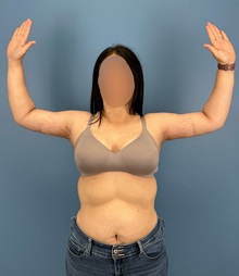 Arm Lift After Photo by Lisa Brostrom, MD; San Antonio, TX - Case 49864