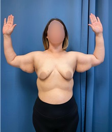 Arm Lift Before Photo by Lisa Brostrom, MD; San Antonio, TX - Case 49864