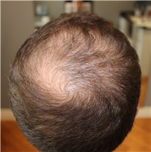 Hair Transplant Before Photo by Ellen Mahony, MD; Westport, CT - Case 49939