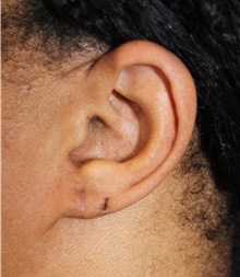 Ear Surgery After Photo by Ellen Mahony, MD; Westport, CT - Case 49944