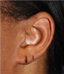 Ear Surgery Before Photo by Ellen Mahony, MD; Westport, CT - Case 49944