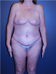 Body Lift After Photo by Michele DeVito, MD FACS; Scottsdale, AZ - Case 49996
