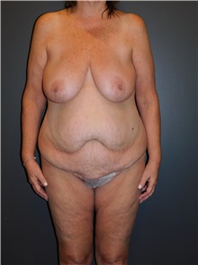 Body Lift Before Photo by Michele DeVito, MD FACS; Scottsdale, AZ - Case 49996
