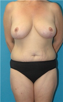 Mommy Makeover Before Photo by Scott Sattler, MD,  FACS; Seattle, WA - Case 49998