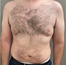 Male Breast Reduction After Photo by Keshav Magge, MD; Bethesda, MD - Case 49550