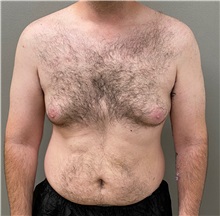 Male Breast Reduction Before Photo by Keshav Magge, MD; Bethesda, MD - Case 49550