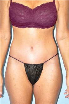 Body Lift After Photo by Keyian Paydar, MD, FACS; Newport Beach, CA - Case 49576