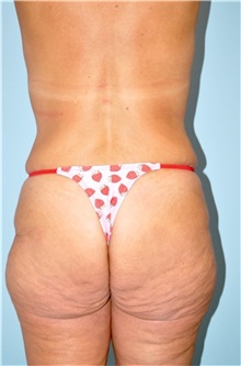 Buttock Lift with Augmentation Before Photo by Keyian Paydar, MD, FACS; Newport Beach, CA - Case 49606