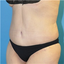 Body Lift After Photo by Joshua Cooper, MD; Seattle, WA - Case 49657