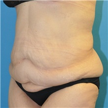 Body Lift Before Photo by Joshua Cooper, MD; Seattle, WA - Case 49657