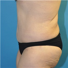 Body Lift After Photo by Joshua Cooper, MD; Seattle, WA - Case 49657