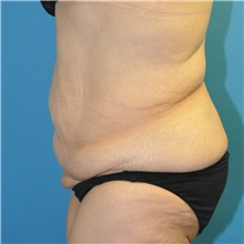 Body Lift Before Photo by Joshua Cooper, MD; Seattle, WA - Case 49657