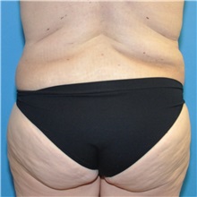 Body Lift After Photo by Joshua Cooper, MD; Seattle, WA - Case 49657