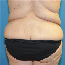 Body Lift Before Photo by Joshua Cooper, MD; Seattle, WA - Case 49657