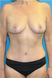 Mommy Makeover After Photo by Joshua Cooper, MD; Seattle, WA - Case 49654