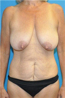 Mommy Makeover Before Photo by Joshua Cooper, MD; Seattle, WA - Case 49654