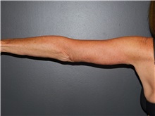 Arm Lift After Photo by Michele DeVito, MD FACS; Scottsdale, AZ - Case 49679