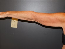 Arm Lift Before Photo by Michele DeVito, MD FACS; Scottsdale, AZ - Case 49679