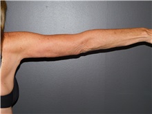 Arm Lift After Photo by Michele DeVito, MD FACS; Scottsdale, AZ - Case 49679