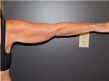 Arm Lift Before Photo by Michele DeVito, MD FACS; Scottsdale, AZ - Case 49679