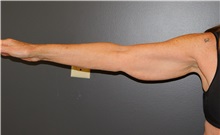 Arm Lift Before Photo by Michele DeVito, MD FACS; Scottsdale, AZ - Case 49679