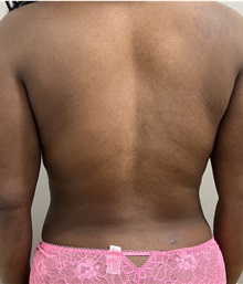 Liposuction After Photo by Franklin Richards, MD; Bethesda, MD - Case 49698