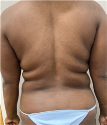 Liposuction Before Photo by Franklin Richards, MD; Bethesda, MD - Case 49698