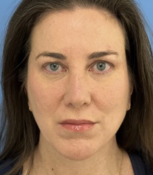 Chin Augmentation After Photo by Michael Epstein, MD, FACS; Northbrook, IL - Case 49741