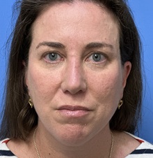 Chin Augmentation Before Photo by Michael Epstein, MD, FACS; Northbrook, IL - Case 49741