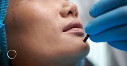 The mid-facelift is taking facial aesthetics by storm