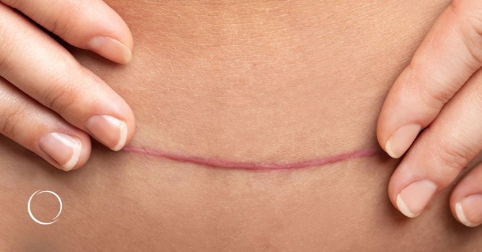 understanding scar discoloration after plastic surgery
