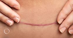 Understanding scar discoloration after plastic surgery