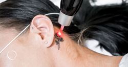 Regret or relief? Options for tattoo removal